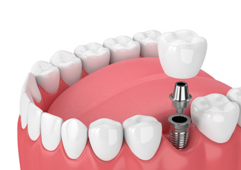 implants_dental