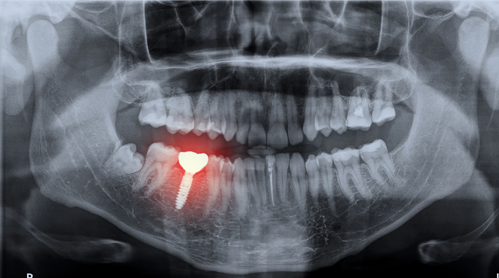 implants_dental