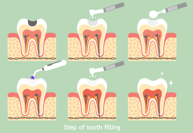 Quick Straight Teeth